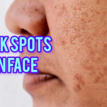 zinc thymulin ghk-cu Psoriasis  Dermatology of Seattle & Bellevue
