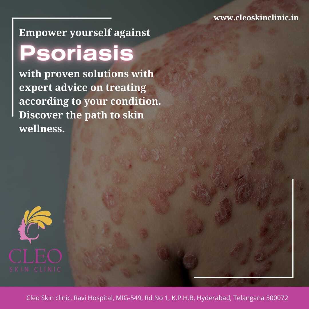 Cleo Skin Clinic Branch in Kukatpally,Hyderabad Best Skin Care