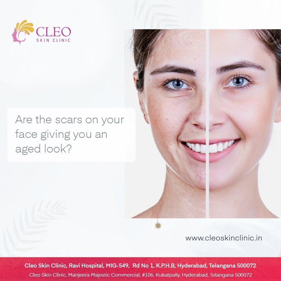 Cleo Skin Clinic Branch in Kukatpally,Hyderabad Best Skin Care