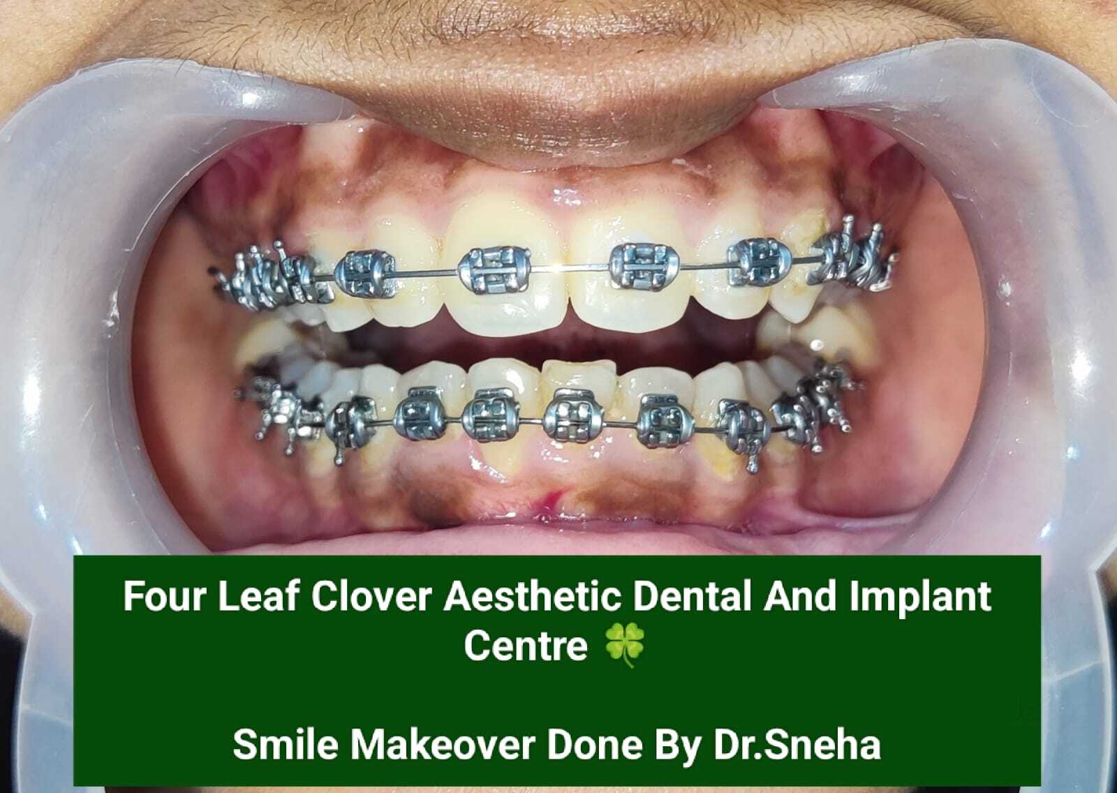 Secrets To Getting dental cleaning fees To Complete Tasks Quickly And Efficiently