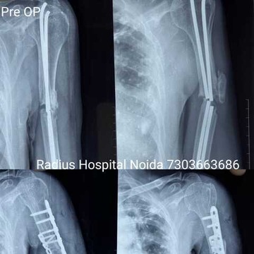 Top Orthopaedic Doctors For Extensor Mechanism Realignment in Sardhana ...