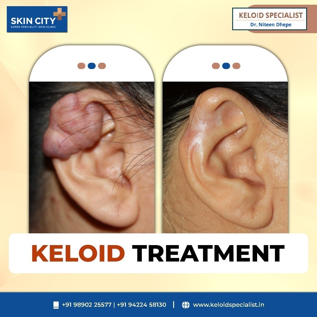 Best Doctors For Acne Treatment Near me in Bijapur Road Sholapur